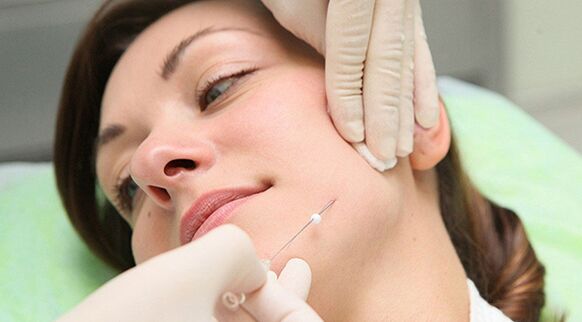 Levantamento de fíos un método de rexuvenecemento cosmético da cara despois de 45 anos
