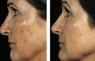 Antes e despois do rexuvenecemento facial fraccionado