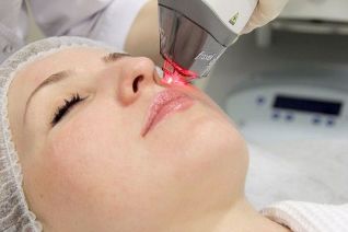 Proceso de rexuvenecemento da pel facial con láser fraccionado