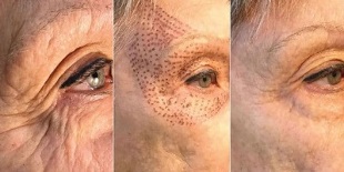 fotos antes e despois do rexuvenecemento da pel no plasma